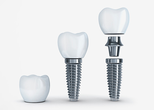 ایمپلنت دندان
