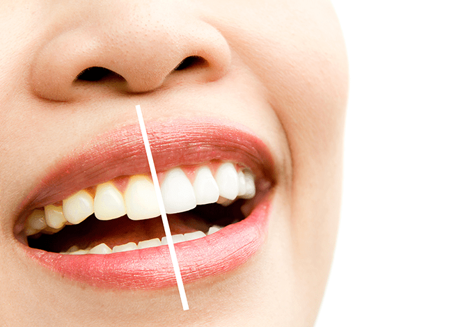 جرم‌گیری دندان‌