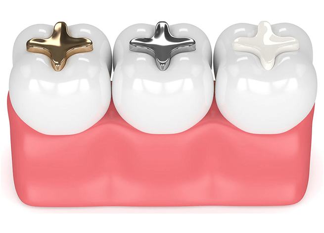 پرکردن دندان