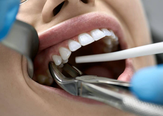 کشیدن دندان