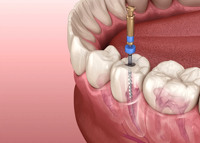 عصب‌کشی دندان‌